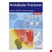 Acetabular Fractures